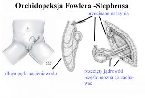 Zabieg metodą Fowlera Stephensa