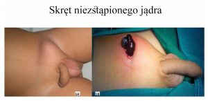 Martwica jądra w wyniku jego skrętu we wnętrostwie Martwica jądra w wyniku jego skrętu we wnętrostwie